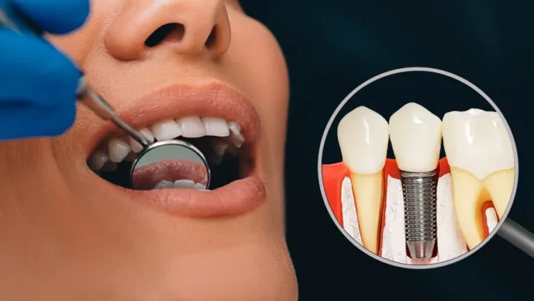 How to Choose the Right Dentist for a Dental Implant
