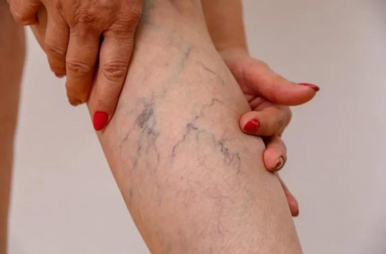 What Causes Spider Veins A Closer Look at Venous Valve Failure
