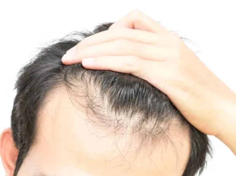 Unlocking the link how HGH and aging shape male hair loss