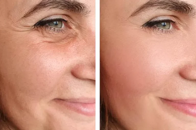 Facelift Near Me Comprehensive Facial Rejuvenation Surgery for Natural, Youthful Results