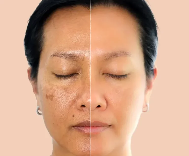 Sun Spot Removal Near Me Effective Pigmentation and Sun Damage Treatments for Clear Skin